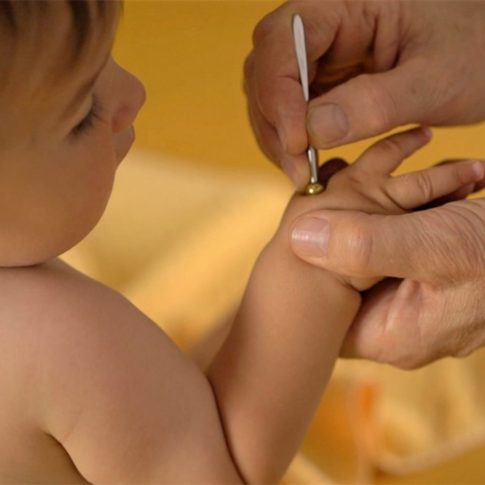 Ein Erwachsener führt eine Shonishin-Behandlung an einem Kleinkind durch und nutzt dabei ein spezielles metallisches Behandlungsinstrument auf der Haut des Kindes vor gelblichem Hintergrund.